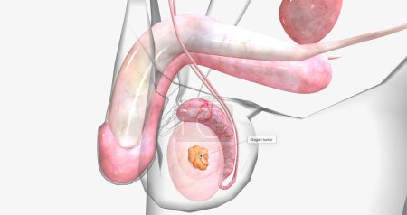 Photo for Stage I testicular cancer is characterized by a tumor that has not spread to the lymph nodes or other organs. 3D rendering - Royalty Free Image