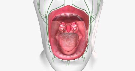 Photo for Strep throat is a common condition caused by a bacterial infection of the mouth and back of the oral cavity. 3D rendering . - Royalty Free Image