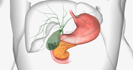 Gallstones are pieces of solid material that form in the gallbladder, a small hollow organ located beneath the liver. 3D rendering