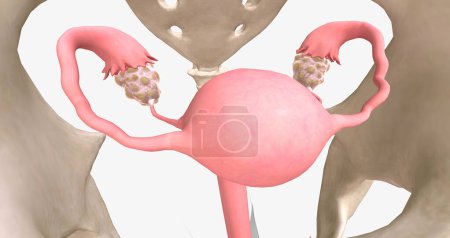 Téléchargez les photos : Polycystic ovary syndrome is an endocrine disorder that affects the ovaries and can lead to cystic effects. 3D rendering - en image libre de droit