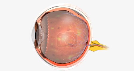 Téléchargez les photos : Diabetic retinopathy is a complication of diabetes that affects the eyes. 3D rendering - en image libre de droit
