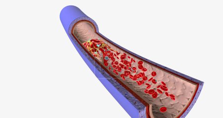 A blood clot in a vein, or venous thrombus, is the clumping of blood in vessels that bring blood back to the heart. 3D rendering