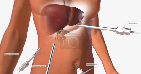 Photo for The ports are hollow channels that provide access for a small camera called a laparoscope and various surgical instruments. 3D rendering - Royalty Free Image
