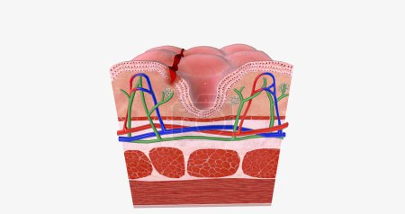 Photo for Anal fissure is a small tear in the lining of the anal mucosa. 3D rendering - Royalty Free Image