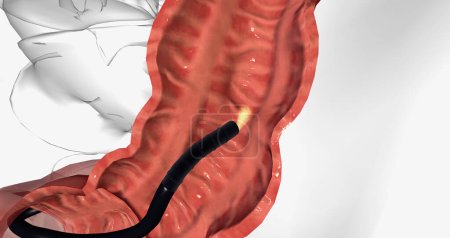 Colonoscopy is most commonly used for colorectal cancer screening. 3D rendering
