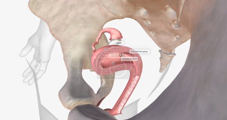 Téléchargez les photos : Endometrial polyps are abnormal growths of the inner lining of the uterus, known as the endometrium. 3D rendering - en image libre de droit