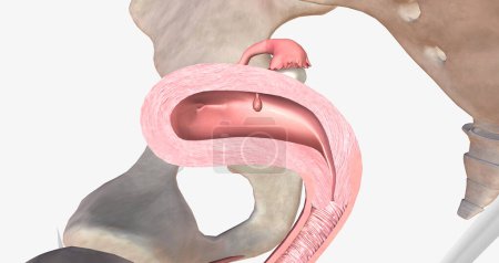 Téléchargez les photos : Endometrial polyps are abnormal growths of the inner lining of the uterus, known as the endometrium. 3D rendering - en image libre de droit