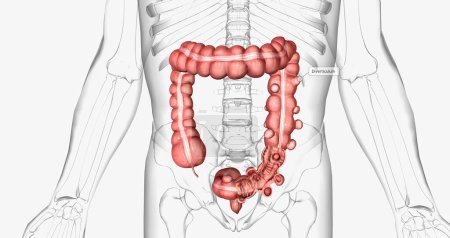 Diverticulosis is a condition characterized by the formation of diverticula in the walls of the intestines. 3D rendering
