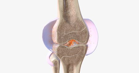 Foto de RA is caused by immune cells attacking the body's own synovial membranes, leading to joint swelling and the formation of auto-antibodies. 3D rendering - Imagen libre de derechos