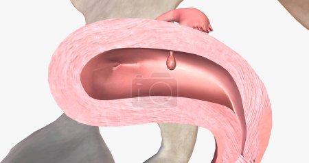 Photo for Endometrial polyps are abnormal growths of the inner lining of the uterus, known as the endometrium. 3D rendering - Royalty Free Image