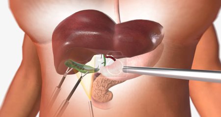 Photo for The Removal of the Gallbladder 3D rendering - Royalty Free Image