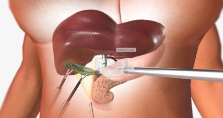 Photo for The Removal of the Gallbladder 3D rendering - Royalty Free Image