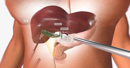 Photo for Locating and Retracting the Gallbladder 3D rendering - Royalty Free Image