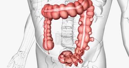 Photo for Diverticulosis is a condition characterized by the formation of diverticula in the walls of the intestines. 3D rendering - Royalty Free Image