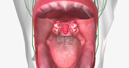 Photo for Strep throat is a common condition caused by a bacterial infection of the mouth and back of the oral cavity. 3D rendering . - Royalty Free Image