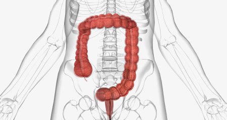 Téléchargez les photos : Colonoscopy is an invasive procedure used to look inside the large intestines. 3D rendering - en image libre de droit