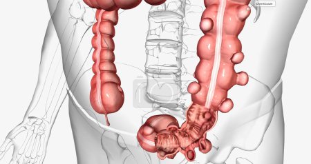 Photo for Diverticulosis is a condition characterized by the formation of diverticula in the walls of the intestines. 3D rendering - Royalty Free Image