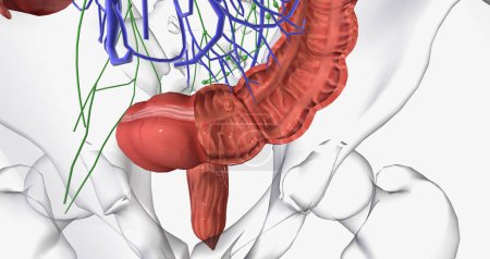 Téléchargez les photos : Colorectal cancer (CRC) is a common colon or rectal cancer that affects many patients over middle age. 3D rendering - en image libre de droit