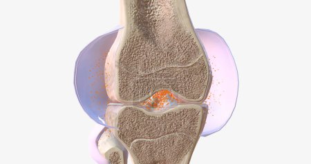 Foto de RA is caused by immune cells attacking the body's own synovial membranes, leading to joint swelling and the formation of auto-antibodies. 3D rendering - Imagen libre de derechos