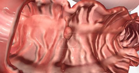 Téléchargez les photos : Adenomatous polyps are gland-like growths that develop on the mucous membrane lining the large intestine. 3D rendering - en image libre de droit