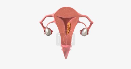 El cáncer de endometrio en estadio II se caracteriza por la diseminación del tumor al cuello uterino. Renderizado 3D