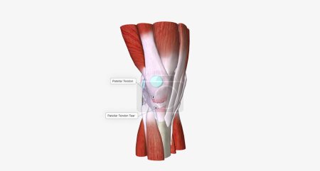 Foto de When a tendon is weakened by age or overuse, trauma can cause it to rupture.3D rendering - Imagen libre de derechos