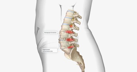 Photo for Degenerative disc disease is characterized by the gradual degeneration of the intervertebral discs. 3D rendering - Royalty Free Image