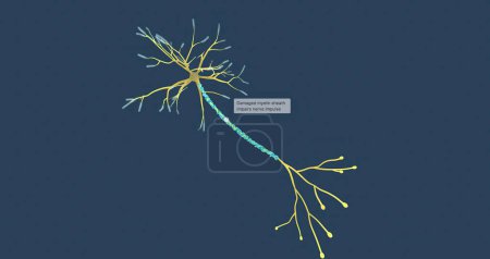 Photo for Damaged myelin sheath impairs nerve impulse 3D rendering - Royalty Free Image