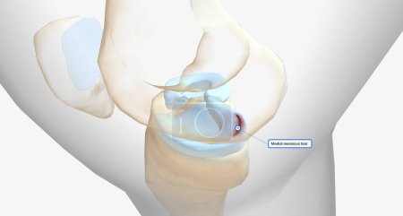 Un desgarro del menisco es una de las lesiones más comunes de la rodilla.Representación 3D