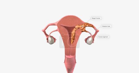 During stage III endometrial cancer, the tumor spreads outside of the uterus. 3D rendering