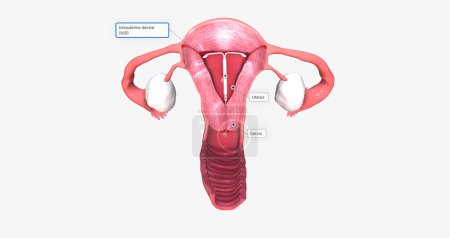 intra uterine device inside fantom uterus 3D rendering