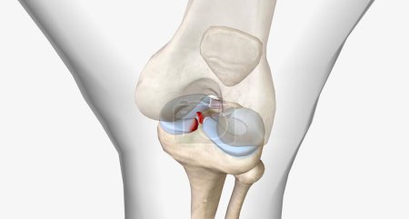 Meniscal root tears are less common than meniscal body tears and frequently go undetected.3D rendering