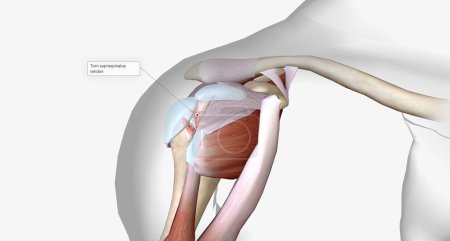 Photo for Torn rotator cuff is a musculoskeletal injury that results from damage to the rotator cuff muscles or tendons.3D rendering - Royalty Free Image