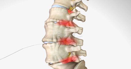 Photo for Degenerative disc disease is characterized by the gradual degeneration of the intervertebral discs. 3D rendering - Royalty Free Image