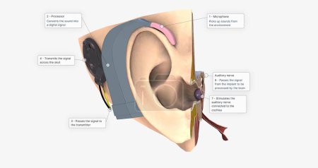 Photo for A cochlear implant is a small, complex electronic device that can help to provide a sense of sound. 3D rendering - Royalty Free Image