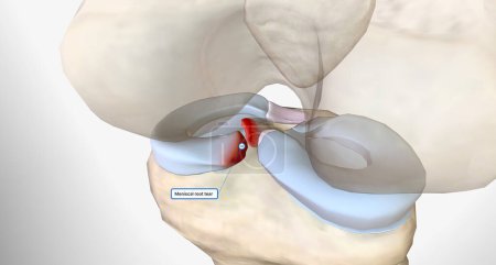 Foto de Meniscal root tears are less common than meniscal body tears and frequently go undetected.3D rendering - Imagen libre de derechos
