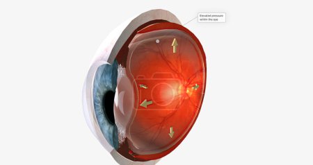 Foto de Ojo humano - glaucoma (enfermedad ocular) Representación 3D - Imagen libre de derechos