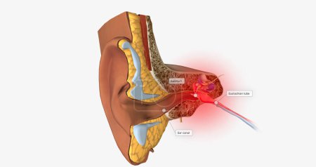 Téléchargez les photos : Earache is a general term for pain in the ear.3D rendering - en image libre de droit