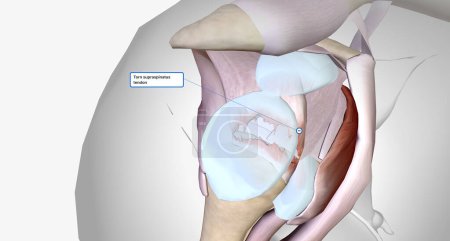 Téléchargez les photos : Torn rotator cuff is a musculoskeletal injury that results from damage to the rotator cuff muscles or tendons.3D rendering - en image libre de droit