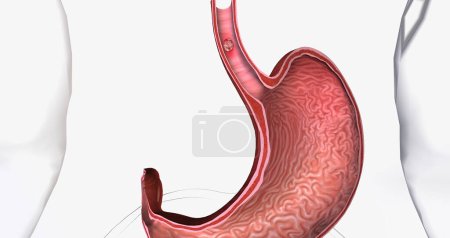 Photo for Squamous cell carcinoma, Cancer that forms in the thin, flat cells lining the inside of the esophagus. 3D rendering - Royalty Free Image