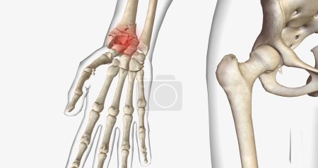 Photo for A fracture, often referred to as a broken bone, is an acute injury that causes a partial or complete break through bone.3D rendering - Royalty Free Image