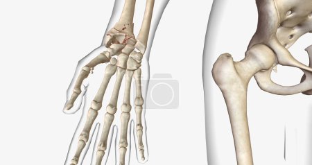 Photo for A fracture, often referred to as a broken bone, is an acute injury that causes a partial or complete break through bone.3D rendering - Royalty Free Image