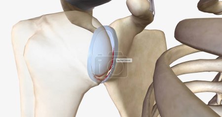 Una lesión de Bankart ocurre como resultado de una luxación de hombro delantera.Representación 3D