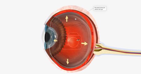Téléchargez les photos : Œil humain - glaucome (maladie oculaire) rendu 3D - en image libre de droit