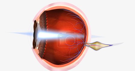 Foto de Hyperopia is a common visual condition in which the eye's ability to focus on nearby objects is impaired.3D rendering - Imagen libre de derechos