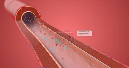Téléchargez les photos : Gestion de l'hypertension artérielle avec médication rendu 3D - en image libre de droit