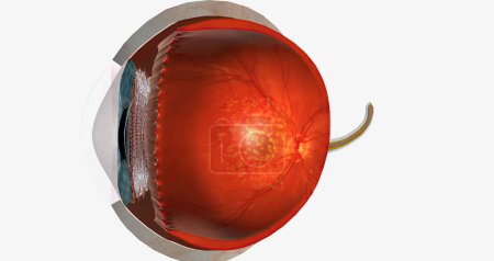 Téléchargez les photos : Dry macular degeneration is a type of age-related vision impairment that results in blurred or lost central vision.3D rendering - en image libre de droit