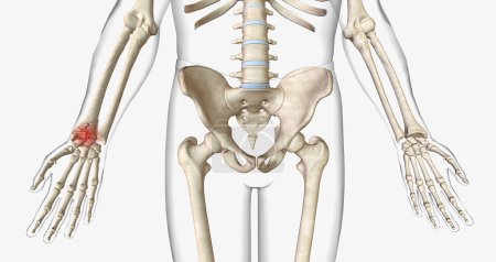 Foto de A fracture, often referred to as a broken bone, is an acute injury that causes a partial or complete break through bone.3D rendering - Imagen libre de derechos