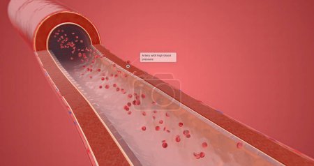 Téléchargez les photos : Artery with high blood pressure 3D rendering - en image libre de droit