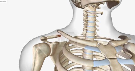 Téléchargez les photos : Une fracture de la clavicule est une fracture de la clavicule, une des os de l'épaule. - en image libre de droit